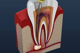 thc root canal